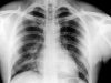 X-Ray of Chest for the Health Examination Working Holiday Visa Australia